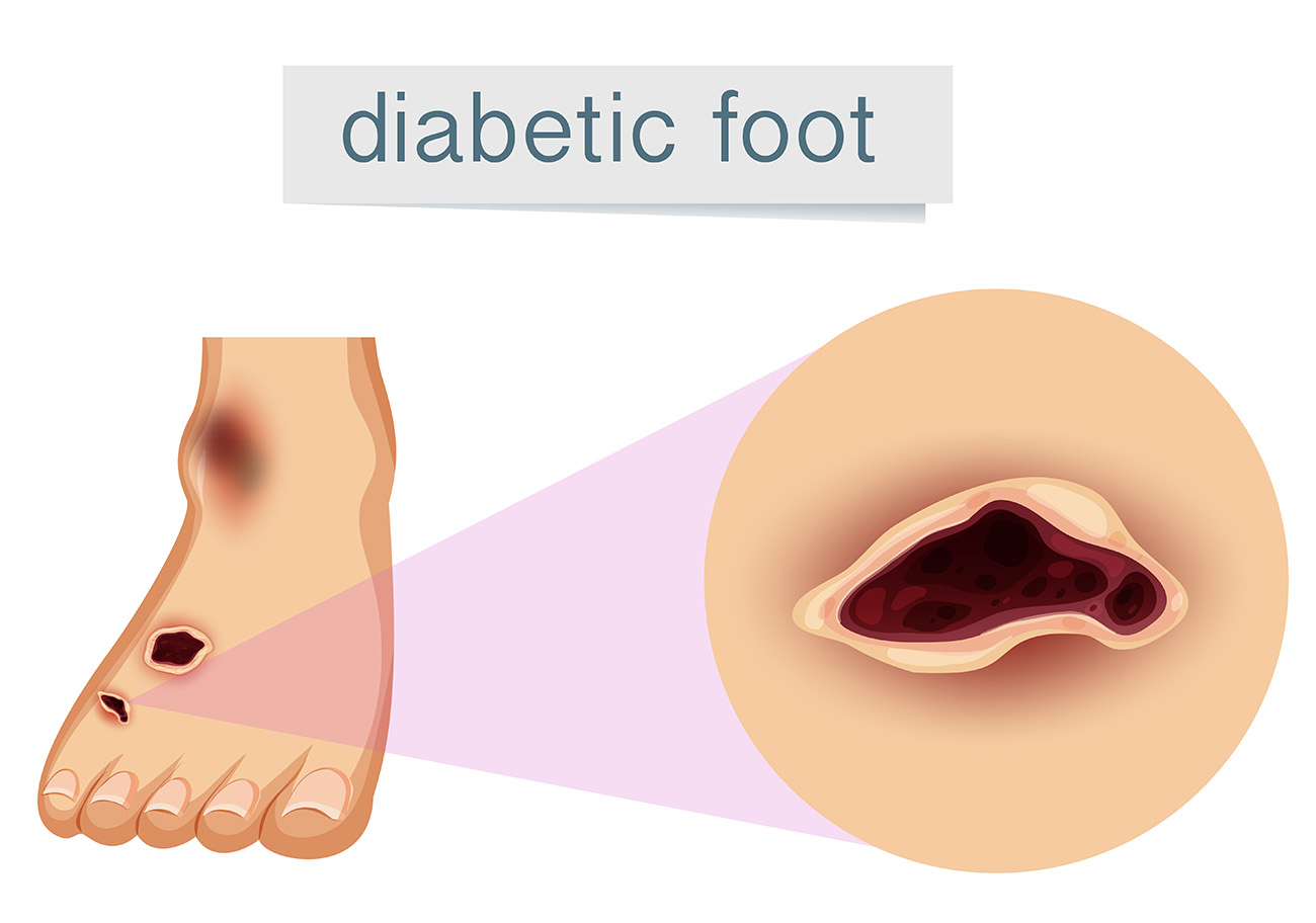 Diabetic Foot Wound