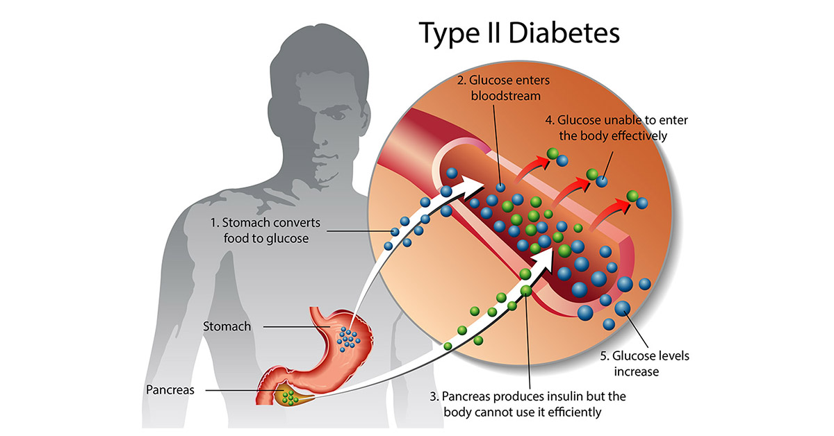 How To Effectively Manage Type 2 Diabetes